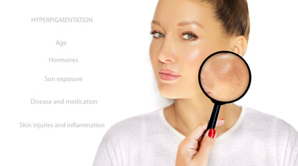 Dark spots, freckles,hyperpigmentation(melasma or chloasma),concept - skin lightening, skin whitening, fruit acids,AHA, Skin Brightening