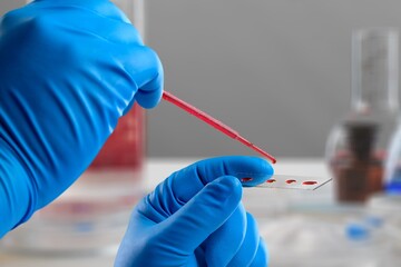 A disease blood test in doctor hand on the background