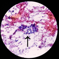 Intra abdominal mass(Cytology): Spindle cell sarcoma, positive malignant cells. Pleomorphic...