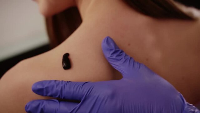 Doctor doing procedure of hirudotherapy for young woman. Woman using leeches to treat the body.Alternative medicine