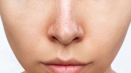 Close-up of woman's nose with black heads or black dots isolated on a white background. Acne problem, comedones. Enlarged pores on the face. Blackheads on greasy skin - obrazy, fototapety, plakaty