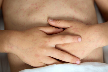 Close-up of the hands of a child with rubella, folded on the stomach. A child with chickenpox lies on his back, folded his hands on his stomach