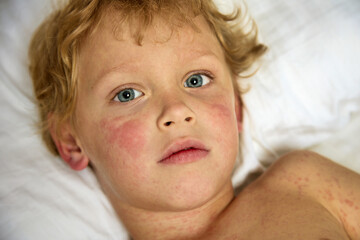 Face of a cute boy lying in bed and suffering from a serious illness on the skin. A strong allergic reaction in the form of a rash covered the entire body and face of the child