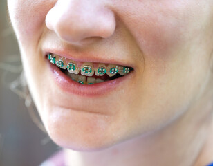 Young woman's smile with metal braces on teeth