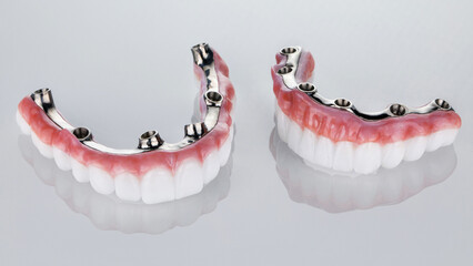perfect composition of the prosthesis of the upper and lower jaws from zircon and titanium bars on...
