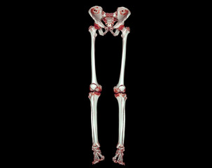 CT scan of lower extremity  3D .
