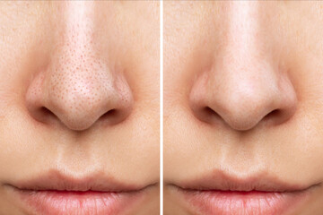 Close-up of woman's nose with blackheads before and after peeling, cleansing the face isolated on a...