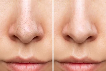 Fotobehang Close-up of woman's nose with blackheads before and after peeling, cleansing the face isolated on a white background. Acne problem, comedones. The result of getting rid of black dots © Марина Демешко