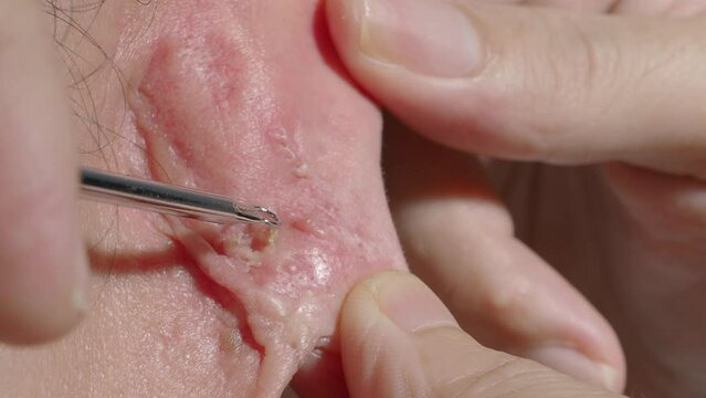 Acne treatment footage. Squeezing blackhead pimple with stainless steel medical acne remover tool. Pressing and removing blackhead pimple from earlobe skin. Acne skin problem closeup skincare concept.