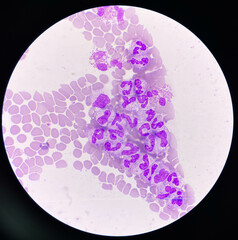 Moderate PMN in septicemia patient.