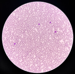 Normochromic and normocytic rbc blood smear.