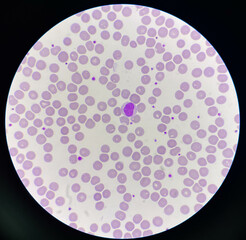 Normochromic and normocytic rbc blood smear.