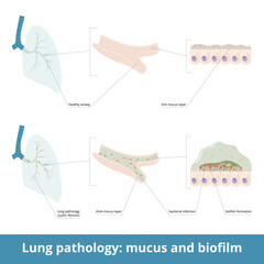 Common lung pathology and excessive mucus. Diseases (cystic fibrosis) may cause the formation of thick mucus in airways, bacterial infection. Biofilm formation in the lungs.