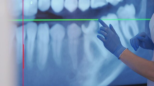 The dentist shows the problem parts of the teeth. X-ray of teeth displayed on the monitor.