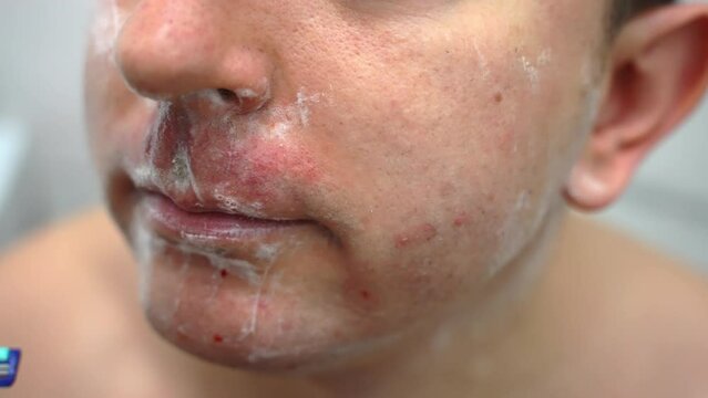 Irritated face skin after daily shaving with sharp razor, man holding morning routine shaving beard and moustache with razor applying moisturizing foam. Sensitive skin irritation, man's daily hygiene