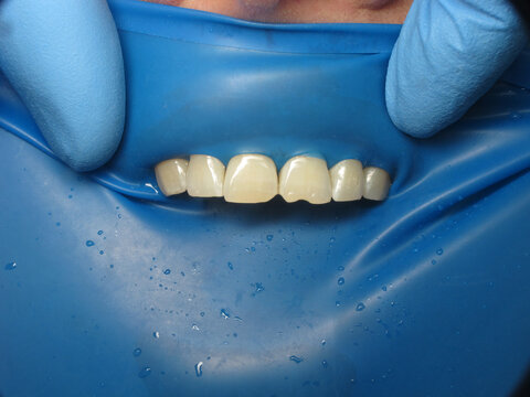 dental treatment at the dentist. filling problematic teeth. special elastic pad on the gums to protect against drops. cofferdam on the teeth