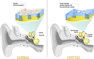 Normal vestibular system and Vertigo when Small calcified otoliths migrate from Saccule and Utricle into the semicircular canals