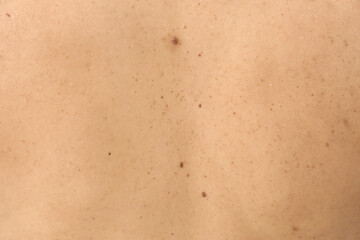 Closeup of woman's body with birthmarks as background