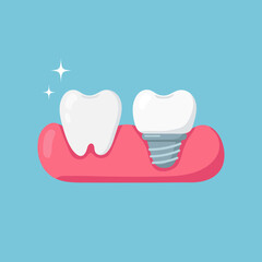 Tooth and tooth implant on blue background. Vector illustration