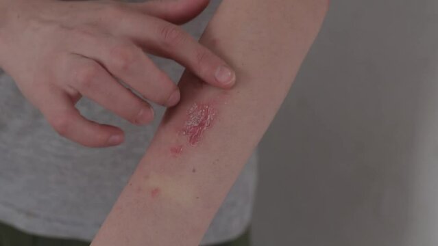 psoriasis en el antebrazo de una mujer, sarpullido escamoso con fisuras lastimadas