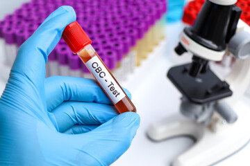 CBC test for abnormalities in red blood cells, Blood samples to be analyzed in the laboratory