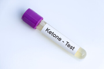 Urine samples for testing Ketones in the laboratory