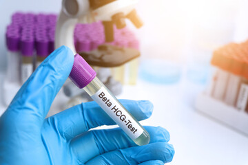 Urine samples for testing HCG in the laboratory