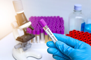 Fototapeta premium Urine samples for testing Bence Jones in the laboratory