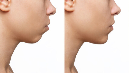 Сhin reduction. Cropped shot of woman's face with chin before and after mentoplasty isolated on a white background. The result of cosmetic plastic surgery. Profile. Сorrection of malocclusion - obrazy, fototapety, plakaty