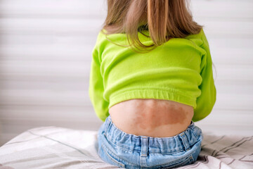 Large red-brown spot on lower back of child from birth. Removal of skin pigmentation and vascular...