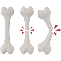 3d rendering of broken bones in different stages