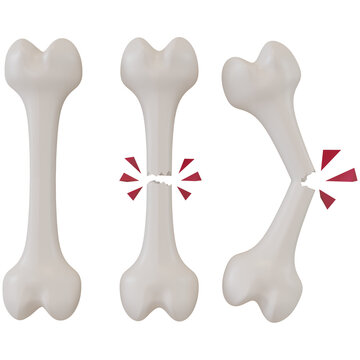 3d rendering of broken bones in different stages