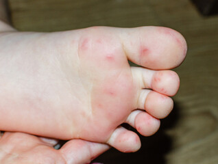 Enterovirus Feet Rash on the body of a child. Cocksackie virus rash beginning initial stage, spots on the feet.