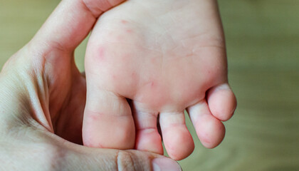 Enterovirus Feet Rash on the body of a child. Cocksackie virus rash beginning initial stage, spots on the feet.