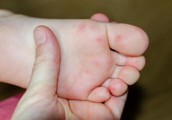 Enterovirus Feet Rash on the body of a child. Cocksackie virus rash beginning initial stage, spots on the feet. - obrazy, fototapety, plakaty