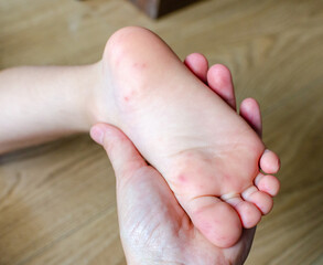 Enterovirus Feet Rash on the body of a child. Cocksackie virus rash beginning initial stage, spots...