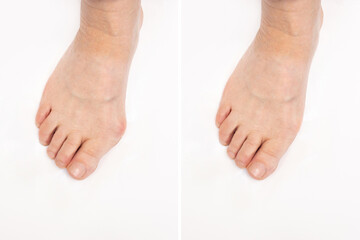 Hallux valgus deformity of the big toe caused by wearing uncomfortable shoes. Elderly woman's foot before and after treatment isolated on a white background. Orthodontics - obrazy, fototapety, plakaty