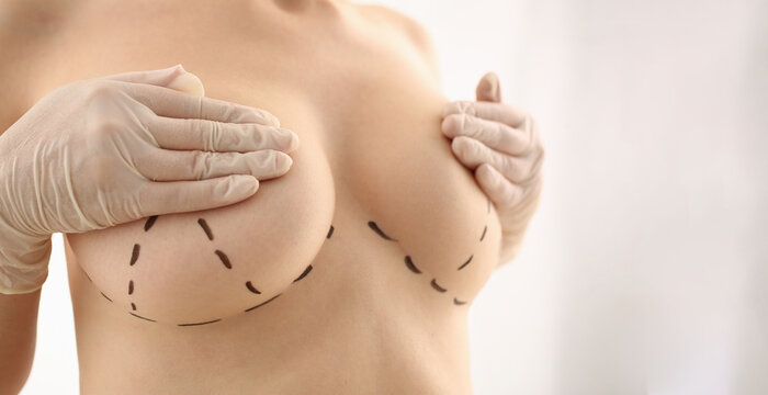 Woman with marks on chest for breast augmentation