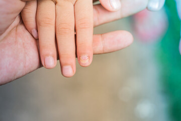 Mechanical damage to the nail plate. Nail Changes Occurring Secondary effect after Hand-Foot-Mouth Disease of kid. Herpangina disease, HFMD.
