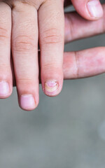 Mechanical damage to the nail plate. Nail Changes Occurring Secondary effect after Hand-Foot-Mouth Disease of kid. Herpangina disease, HFMD.
