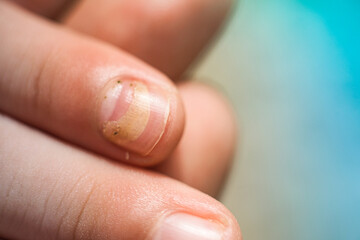 Fototapeta premium Mechanical damage to the nail plate. Nail Changes Occurring Secondary effect after Hand-Foot-Mouth Disease of kid. Herpangina disease, HFMD. 
