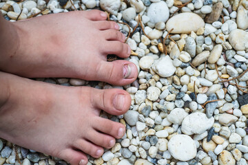 Mechanical damage to the nail plate. Nail Changes Occurring Secondary effect after Hand-Foot-Mouth Disease of kid. Herpangina disease, HFMD.
