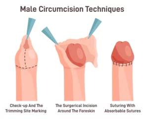 Fotobehang Circumcision technique. Surgical removal of the foreskin on the penis of man. © inspiring.team
