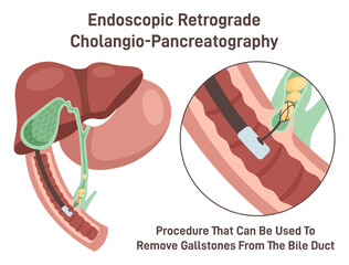 Endoscopic retrograde cholangiopancreatography. ERCP, bile duct diagnosis. - obrazy, fototapety, plakaty