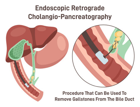 Endoscopic retrograde cholangiopancreatography. ERCP, bile duct diagnosis.