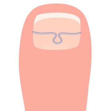 pink toe with wire, medical treatment clip art preview