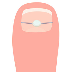 Thumb with a titanium staple for correction of the shape of the toenail. Thumb cartoon vector illustration isolated on a white background