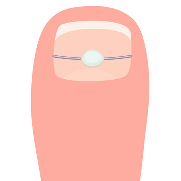 pink toe with ingrown toenail treatment clip art preview