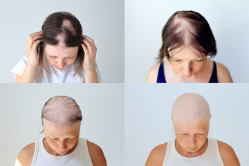 Stages of female head baldness during autoimmune alopecia. Baldness during chemotherapy for cancer