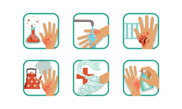 Burns Degree and First Aid or Treatment with Wounded Hand Vector Set
